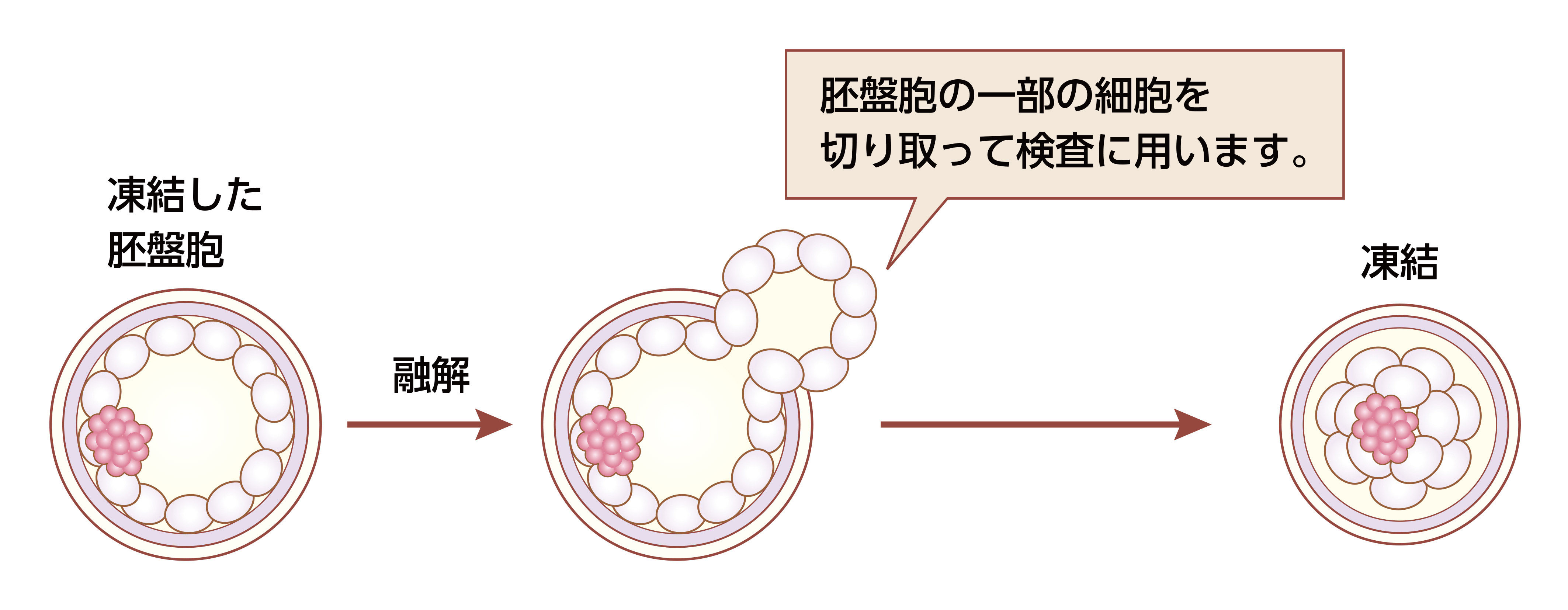 凍結した胚盤胞→融解→胚盤胞の一部の細胞を切り取って検査に用います。→凍結